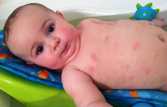 家有過(guò)敏體質(zhì)的寶寶看過(guò)來(lái)，容易引起過(guò)敏的食物清單大放送