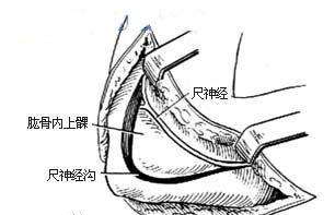 尺神經(jīng)損傷的癥狀