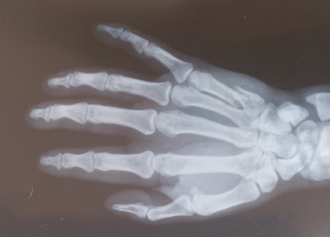 第一掌骨基部骨折示意圖