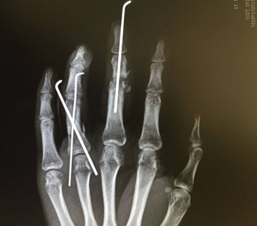 斷指再植示意圖