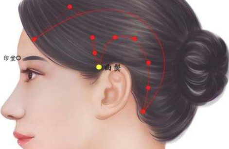 針刺曲鬢穴治療中風偏癱