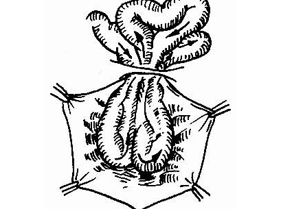 腹壁壞死性筋膜炎