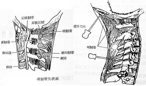 頸部開放性損傷示意圖