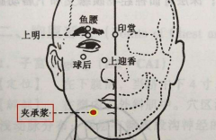 中醫(yī)夾針灸承漿穴治療三