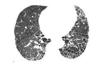 蜂窩肺綜合征癥狀