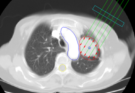 放射性肺炎的診斷