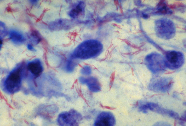 非結(jié)核分枝桿菌病的診斷方法