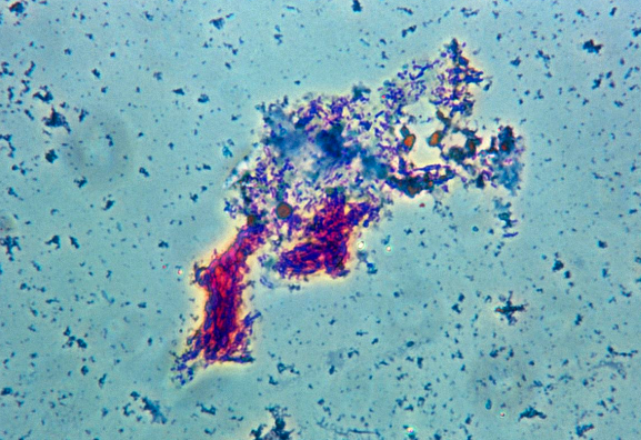 非結(jié)核分枝桿菌病的鑒別