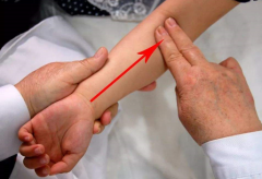 中醫(yī)教你針刺曲澤穴治療