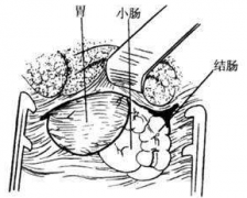 創(chuàng)傷性膈疝的癥狀表現(xiàn)及其治療方法有哪些？