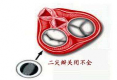 二尖瓣關(guān)閉不全是什么原因引起的？二尖瓣關(guān)閉不全食療方