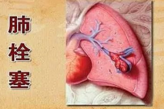 肺栓塞會(huì)猝死嗎？肺栓塞的癥狀表現(xiàn)及其護(hù)理方法！