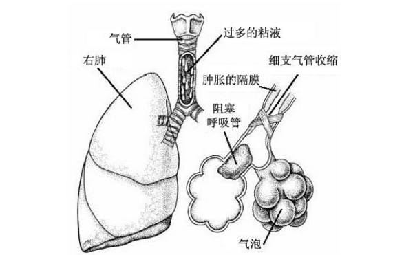 肺炎鏈球菌肺炎的發(fā)病原因